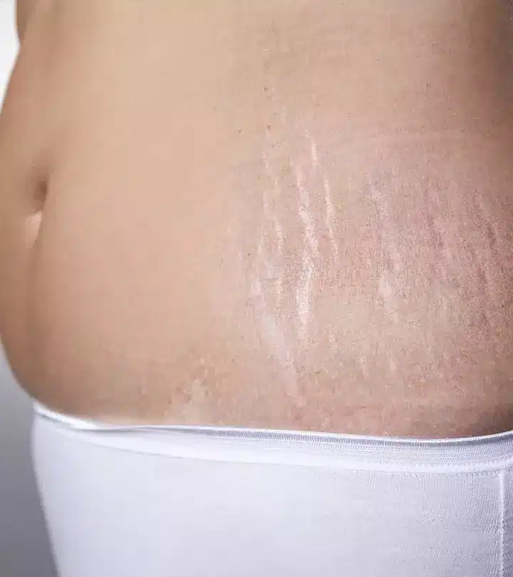 آشنایی با رفع استرچ مارک و ترک پوستی