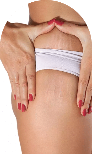 رفع استرچ مارک و ترک پوستی