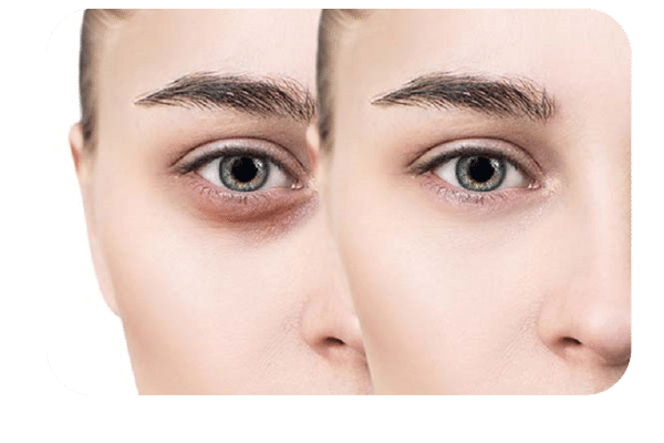 آشنایی با کربوکسی تراپی