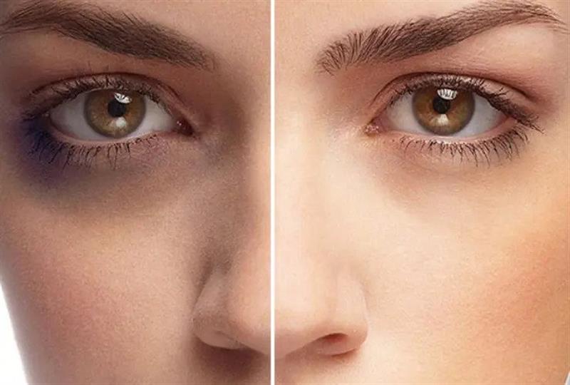 خدماتی که در کلینیک هانی برای درمان تیرگی زیر چشم ارائه میشود: