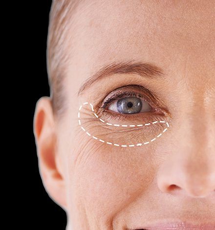 آشنایی با ژل-فیلر زیر چشم