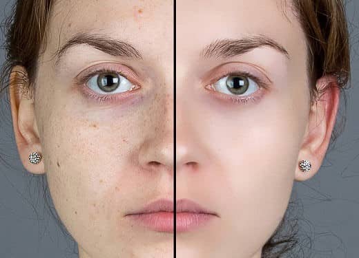 عملکرد کوکتل های مزوتراپی رفع لک و روشن کنندگی پوست